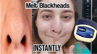 I Removed My Blackheads Instantly Korean trick. how to get rid of blackheads Wealth