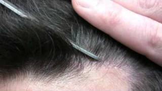 Dr Hasson Hair Transplant - 1750 grafts - 1 Hair Transplant Surgery