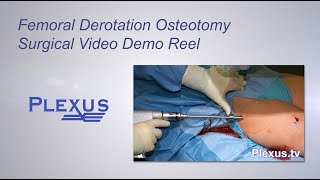 Bilateral Femoral Derotational Osteotomies Surgical Video