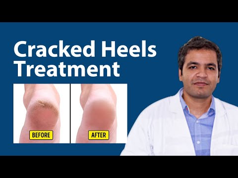 Video: Treatment Of Cracked Heels With Folk Remedies And Methods