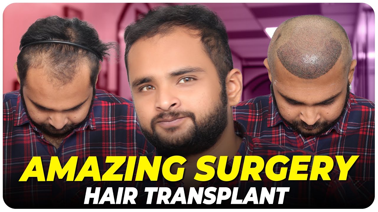 Hair Transplant in India Best Results & Cost of Hair Transplant in