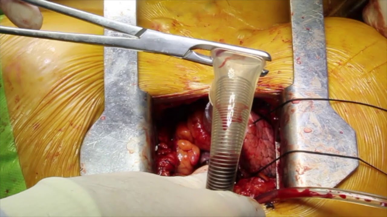 Ministernotomy for Aortic Valve Replacement