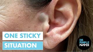 ONE STICKY SITUATION | Dr. Pimple Popper Removes an Ear Cyst