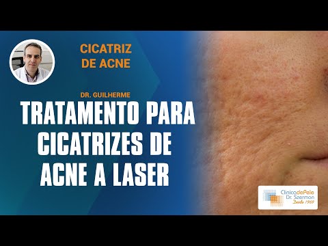 Acne &amp; Cicatrizes 2 I Laser Pixel Erbium Fracionado