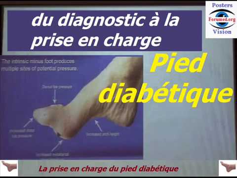 Vidéo: Pied De Charcot: Causes, Symptômes Et Traitement