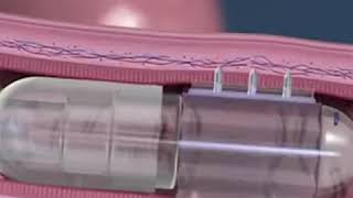 Robotic needle