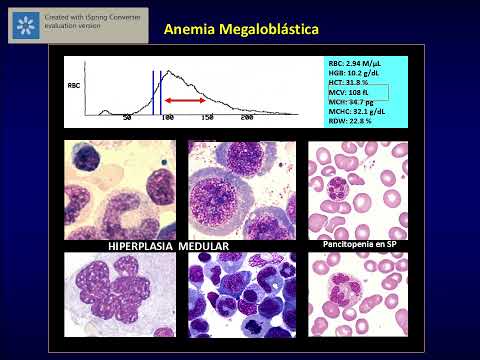 TEÓRICO 4 Anemia Megaloblástica