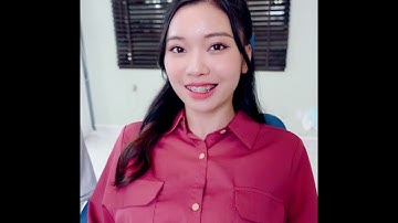 [KẾT QUẢ] NIỀNG RĂNG HÔ - KHẤP KHỂNH SAU 15 THÁNG - KH DIỄM QUỲNH