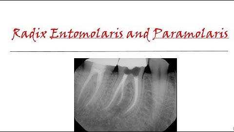 Radix entomolaris and paramolaris