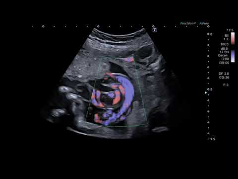 9. SMI - Umbilical Cord | Ultrasound Aplio a-series | Canon Medical ...