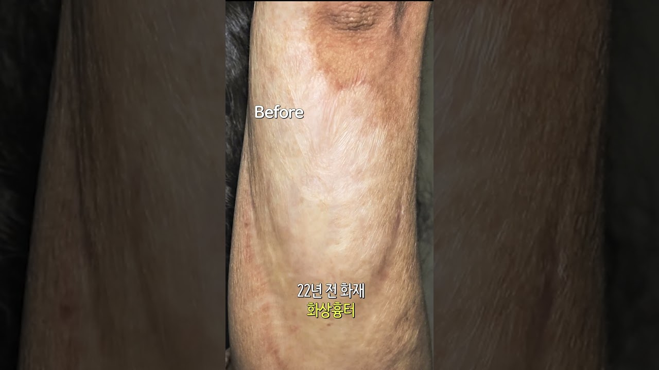 22년 전 화재로 생긴 화상흉터! 대학병원에서도 치료가 어렵다고 했던 환자분 치료 사례????