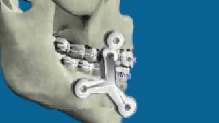 Mentoplastia de Avance