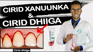 XANUUNKA YIRIDKA AMA CIRID DHIIGA IYO SIDA LOO DAAWEEYO  |  GINGIVITIS