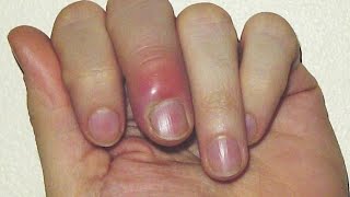 وصفة مجربة ومضمونة لعلاج الأصبع المدوحس بدون أدوية