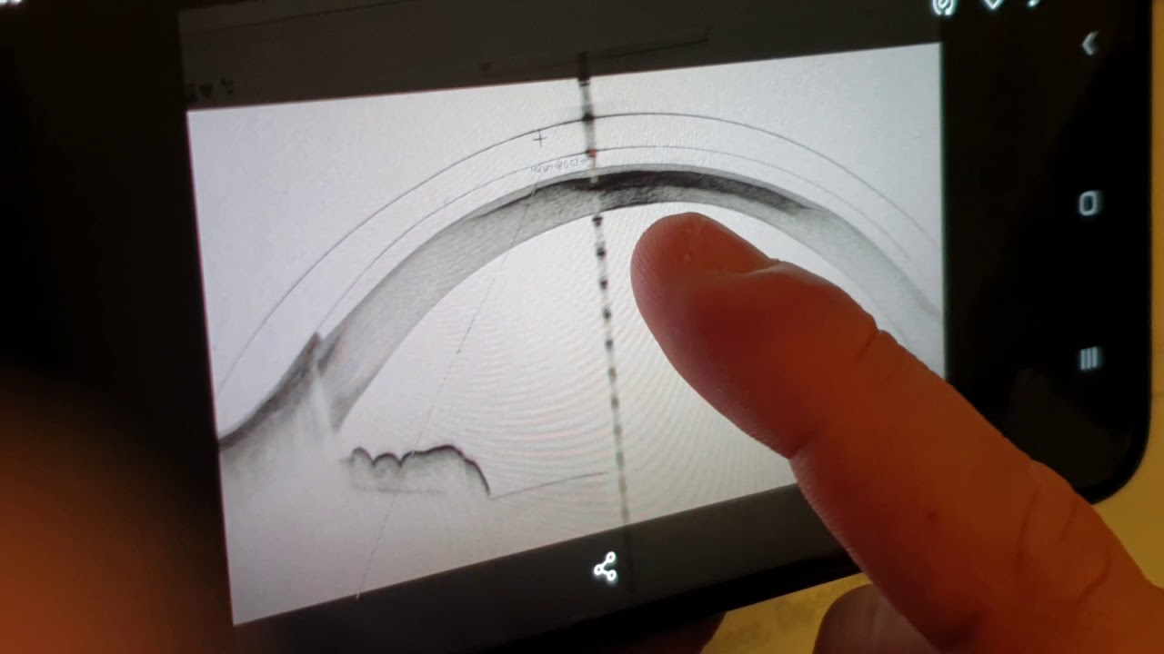 Les miracles des lentilles sclerales