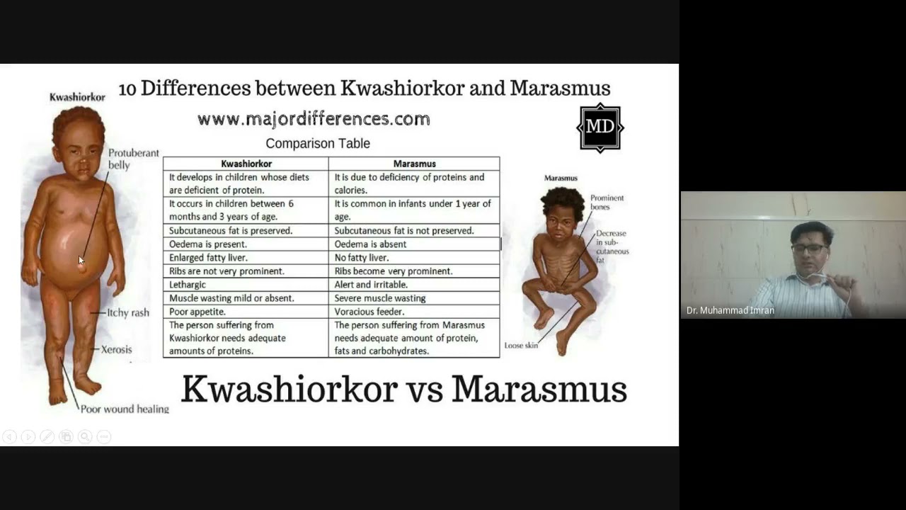 Kwashiorkor And Marasmus What S The Difference Youtube