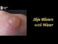 Skin Blisters with Water: Causes, Treatment, Draining, Prevention - Dr.Aruna Prasad | Doctors Circle