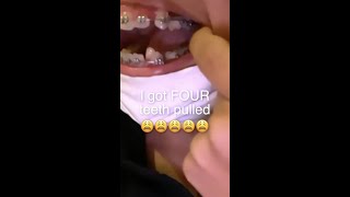 Exclusive What Happens To Gaps When Teeth Are Pulled For Braces? 😩 Information
