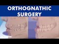 Orthognathic surgery and Orthodontics - How is it done? ©