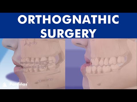 ORTHOGNATHIC surgery - All about JAW realignment surgery ©