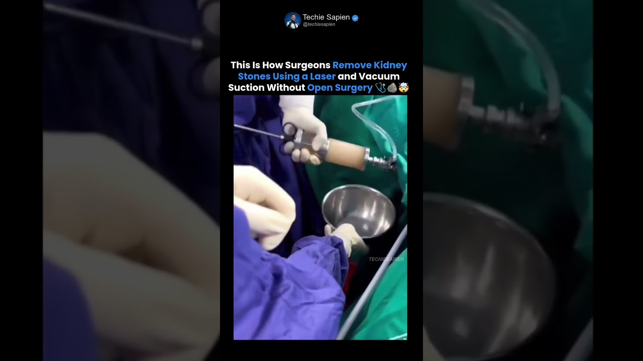 The Incredible Procedure That Removes Kidney Stones Without Major Surgery 🤯
