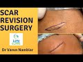 Scar Revision Surgery | Dr Nambiar&#39;s Face Clinic | Dr. Varun Nambiar