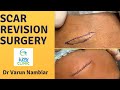 Scar Revision Surgery | Dr Nambiar's Face Clinic | Dr. Varun Nambiar