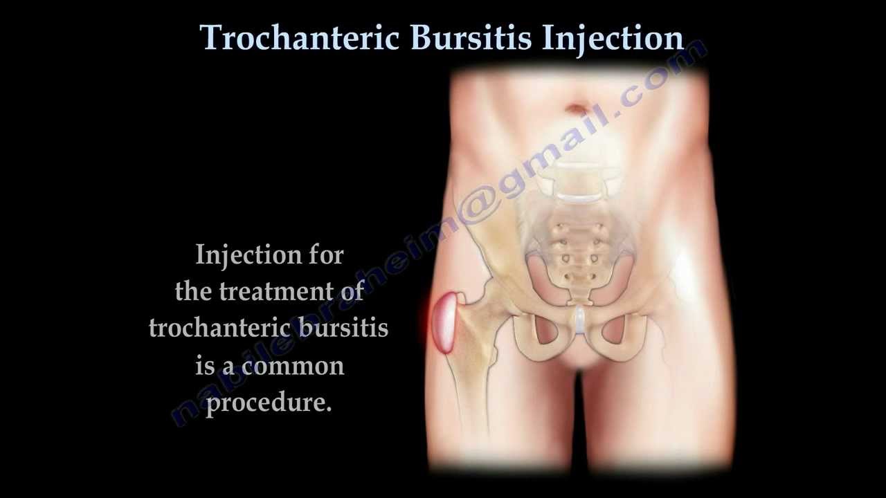 csípőízület trochanteritis)