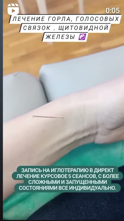Лечение горла, голосовых связок с помощью Иглотерапии. За 1 сеанс ...