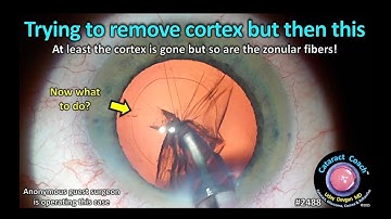 CataractCoach™ 2488: probeer cortex te verwijderen, maar dan dit...