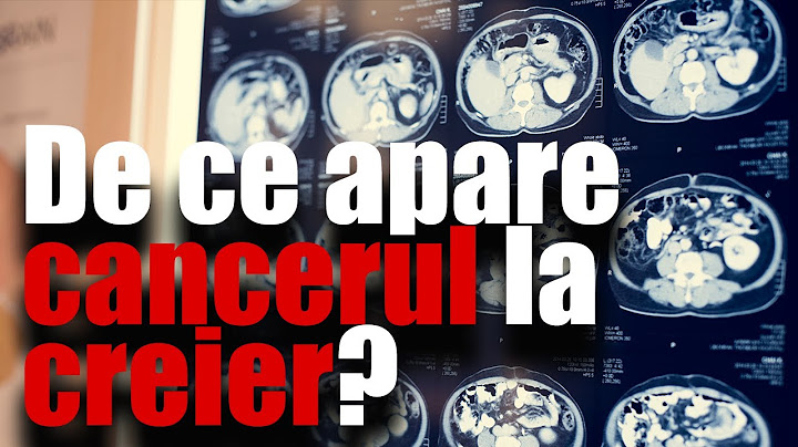 De ce apare cancerul la creier? Vine cu explicații reputatul neurochirurg Alexandru Vladimir Ciurea!