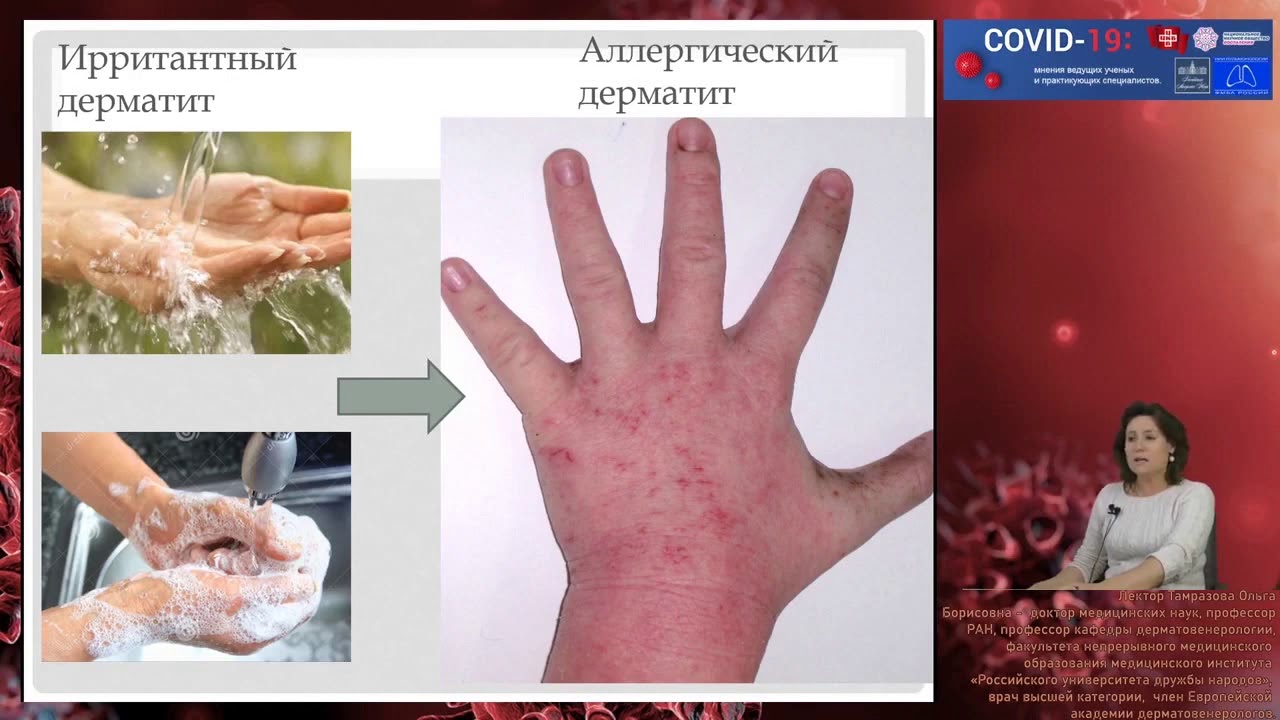 Профессиональные дерматозы: дерматиты кистей и синдром раздраженной кожи лица