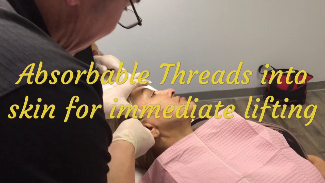 Thread Lift Sutures Face Lift in Austin YouTube