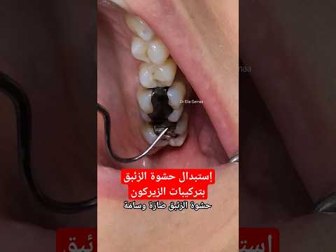 حشوة الزئبق وتلبيس اسنان الزيركون