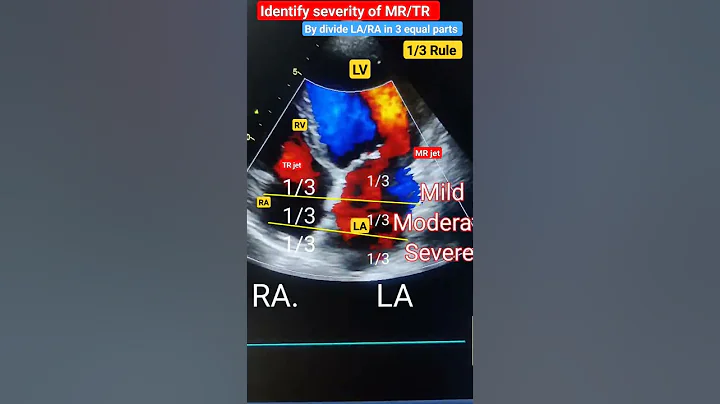 Mild, moderate,severe MR,TR in Echo by 1/3 rule #echo  #shorts