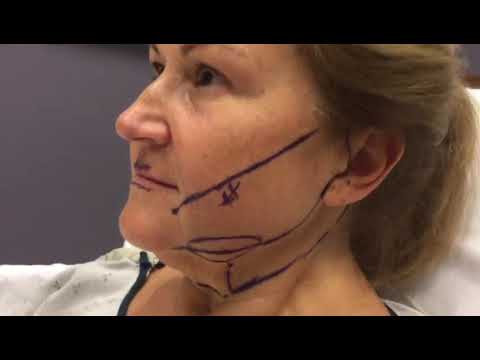 Full Face Transformation! Lower Facelift, Buccal Fat Removal, and Fat Transfer to Lips