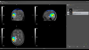 BrainMagix: MRI-PET Fusion in a Patient with a Brain Tumor
