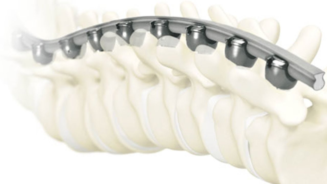 K2M IPO Could be the Backbone of the Spine Surgery Market