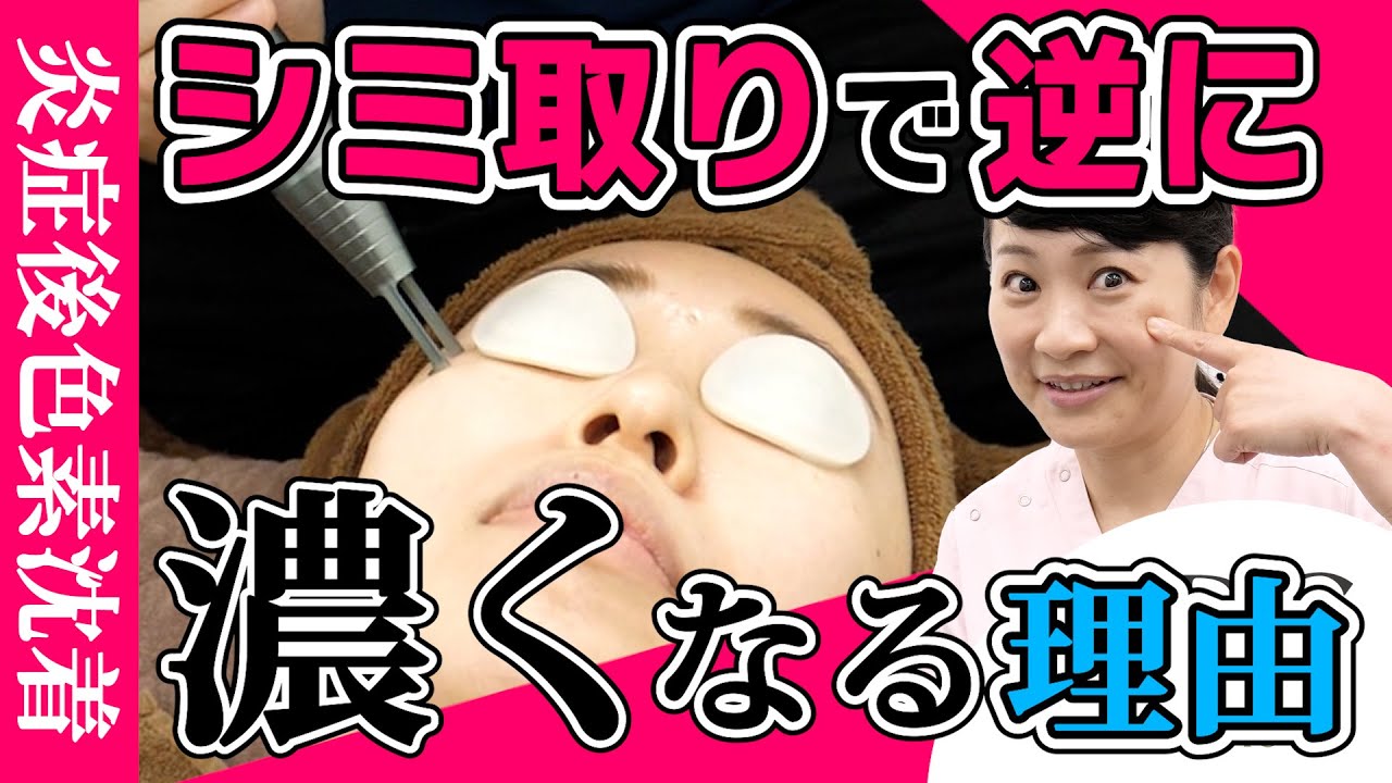 【シミ取りの悲劇】レーザー治療しない方がいい人の特徴を解説します【肝斑治療が厄介な理由】湘南美容クリニック