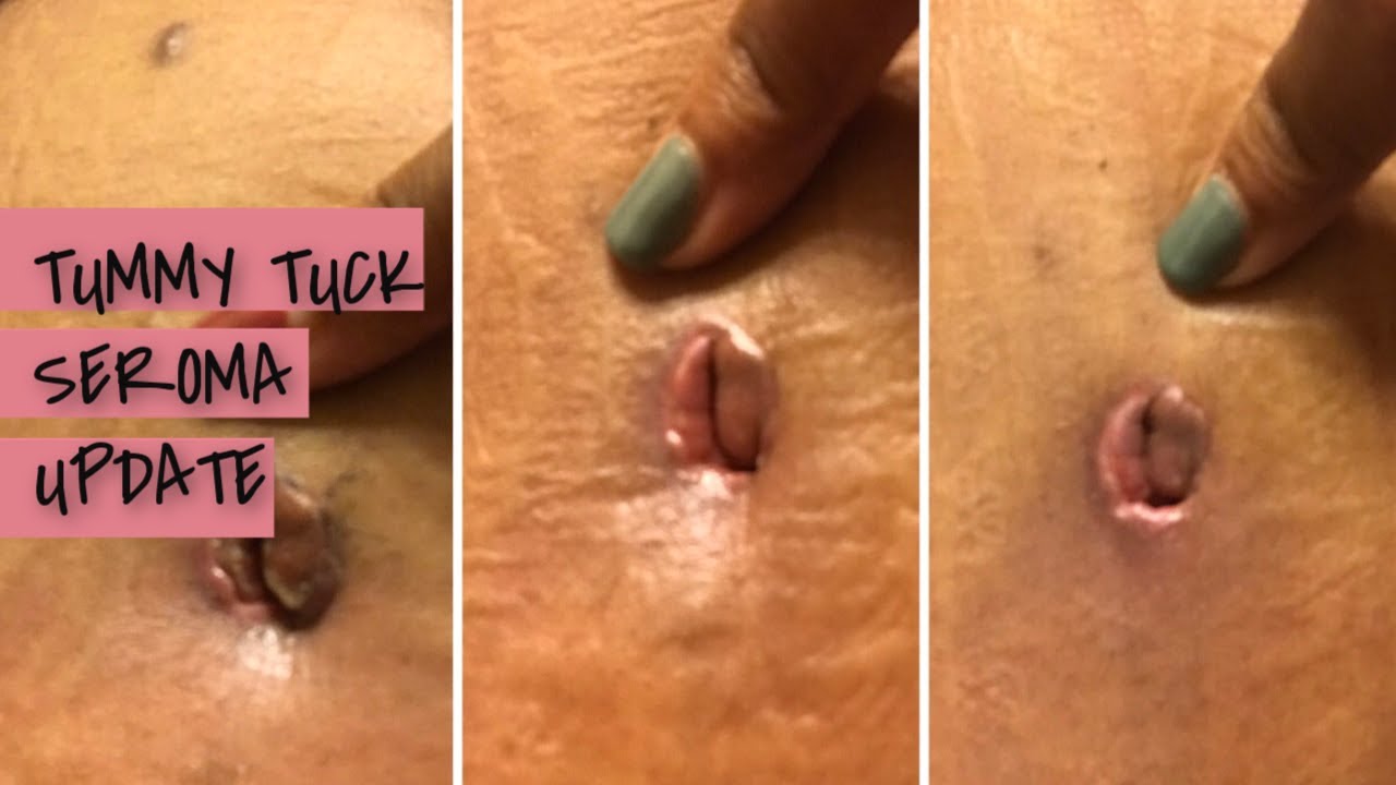 Tummy Tuck - Seroma update | belly button leakage