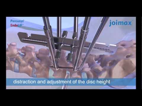Spinal stabilization with joimax® Percusys® screw-rod system and EndoLIF® O-Cage