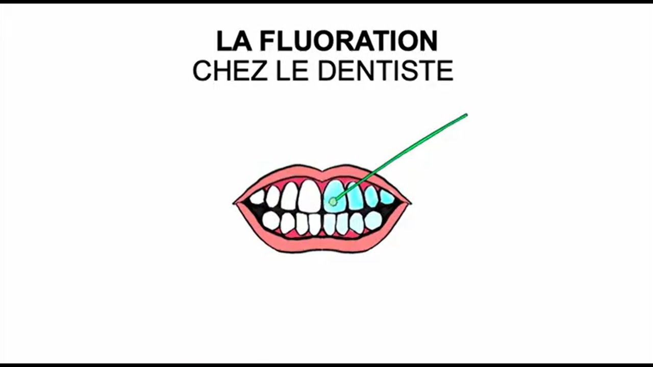 La fluoration chez le dentiste