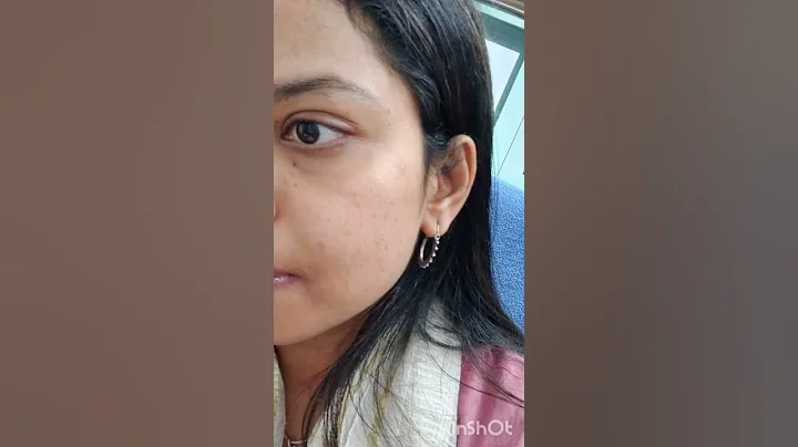 Update on my acne journey. #short #shortvideos #acne #acnetreatment #skintreatment
