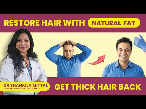 Nanofat Grafting for Hair Fall: Stem Cell Therapy Explained by Dermatologist