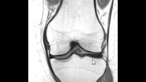 How to Read an MRI of the Knee | First Look MRI