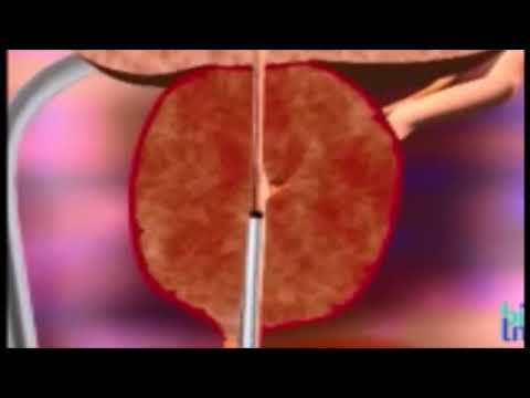 Video: Quando eseguire la prostatectomia transuretrale?