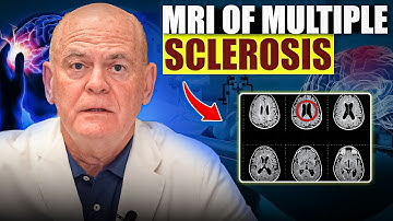 What Your Brain MRI Really Says About Multiple Sclerosis vs. Strokes