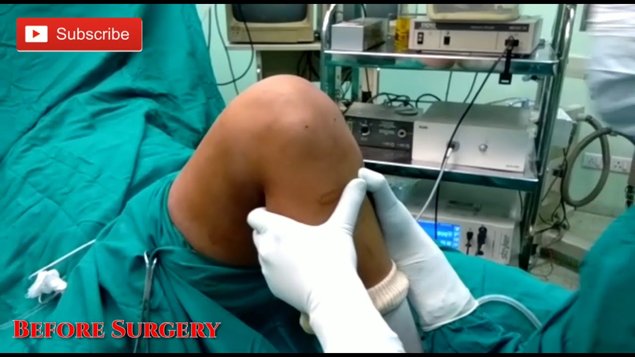 Anterior cruciate ligament (ACL) surgery in JaipurBest