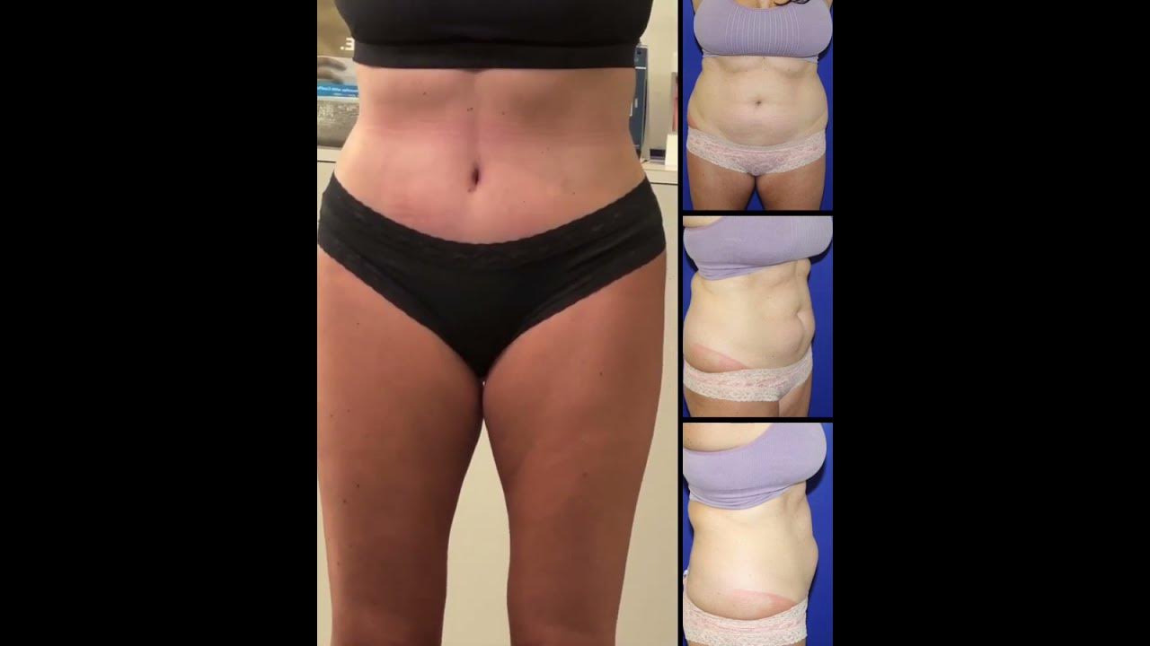 Am I A Good Candidate For A Tummy Tuck? — HZ Plastic Surgery