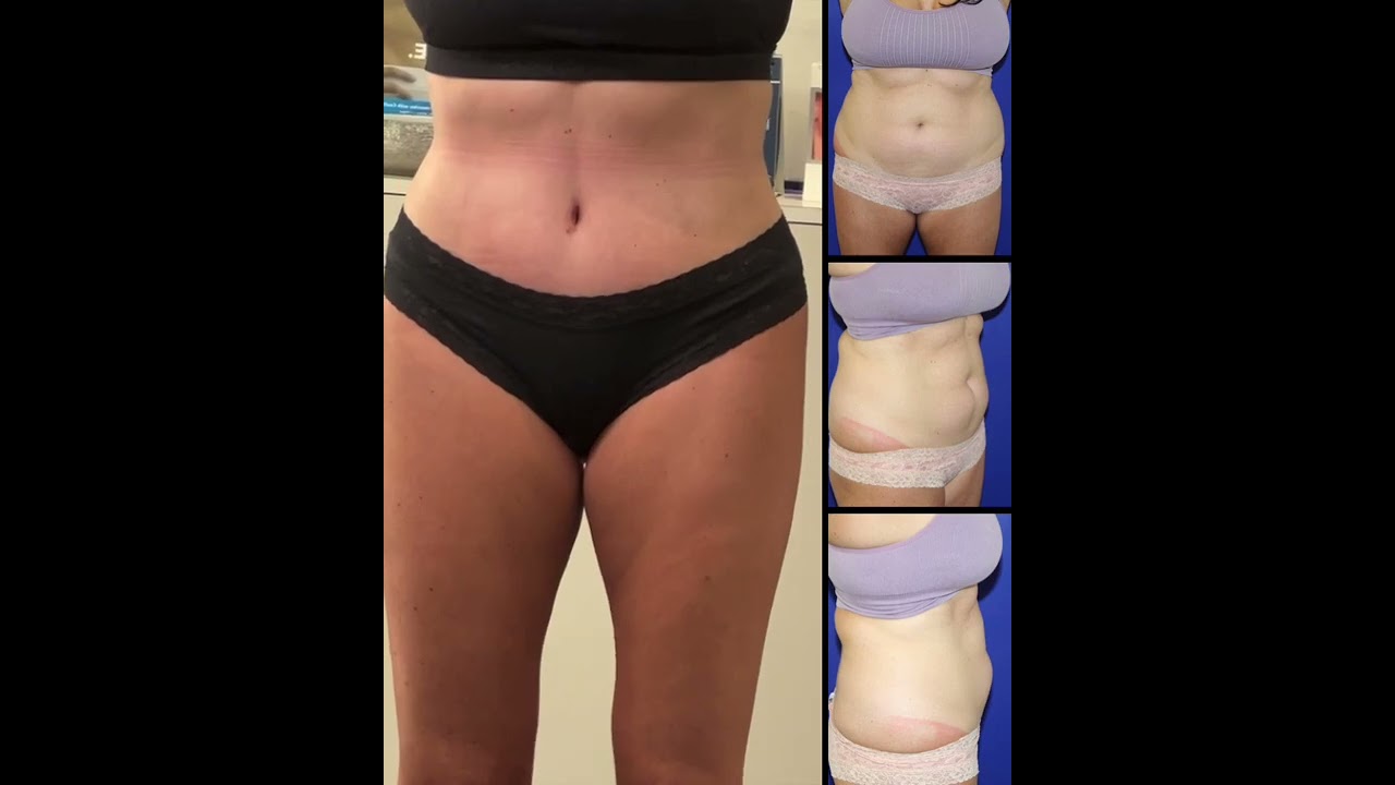 Tummy Tuck Recovery and Follow Up - Tampa Palms Plastic Surgery